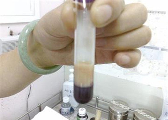 35�����Ӷٶٴ������Ӳ��ڼҳԷ�_ѪҺ��ɫ��ͼ��