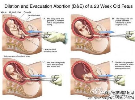 做人流时,胎儿的感受是怎样的? 做人流时,胎儿的感受是怎样的?