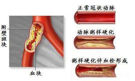 Ѫ�ܶ���ʱ���ио���