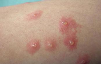 自制大悲水,治愈尖锐湿疣 自制大悲水,治愈尖锐湿疣