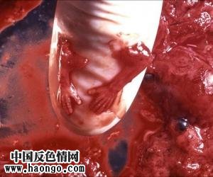 打胎胎儿真实照片(胆小,心脏病勿入!) 打胎胎儿真实照片(胆小,心脏病勿入!)