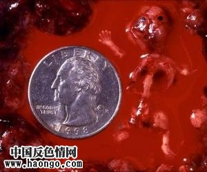 打胎胎儿真实照片(胆小,心脏病勿入!) 打胎胎儿真实照片(胆小,心脏病勿入!)