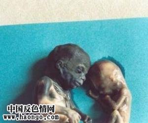 打胎胎儿真实照片(胆小,心脏病勿入!) 打胎胎儿真实照片(胆小,心脏病勿入!)