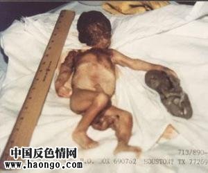 打胎胎儿真实照片(胆小,心脏病勿入!) 打胎胎儿真实照片(胆小,心脏病勿入!)