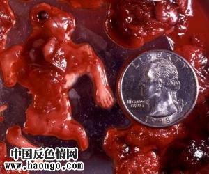 打胎胎儿真实照片(胆小,心脏病勿入!) 打胎胎儿真实照片(胆小,心脏病勿入!)