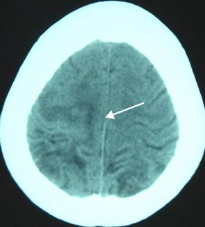 蛙腿好吃,却毁了一个家庭!脑中揪出半米长寄生虫! 蛙腿好吃,却毁了一个家庭!脑中揪出半米长寄生虫!