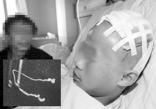 蛙腿好吃,却毁了一个家庭!脑中揪出半米长寄生虫! 蛙腿好吃,却毁了一个家庭!脑中揪出半米长寄生虫!