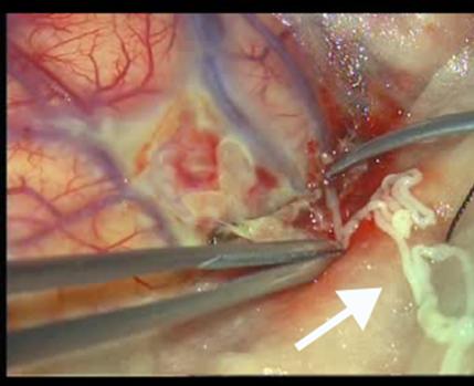 蛙腿好吃,却毁了一个家庭!脑中揪出半米长寄生虫! 蛙腿好吃,却毁了一个家庭!脑中揪出半米长寄生虫!