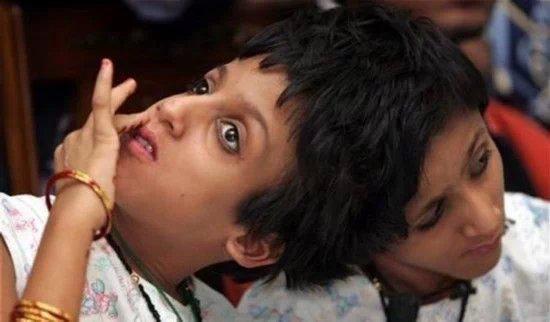 全球奇特的连体人!你一定没见过! 全球奇特的连体人!你一定没见过!