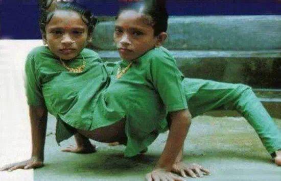 全球奇特的连体人!你一定没见过! 全球奇特的连体人!你一定没见过!