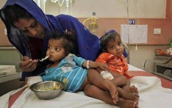 全球奇特的连体人!你一定没见过! 全球奇特的连体人!你一定没见过!