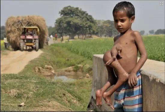 全球奇特的连体人!你一定没见过! 全球奇特的连体人!你一定没见过!