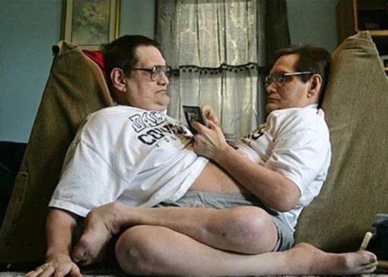 全球奇特的连体人!你一定没见过! 全球奇特的连体人!你一定没见过!