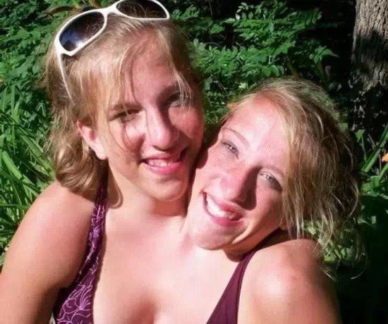 全球奇特的连体人!你一定没见过! 全球奇特的连体人!你一定没见过!