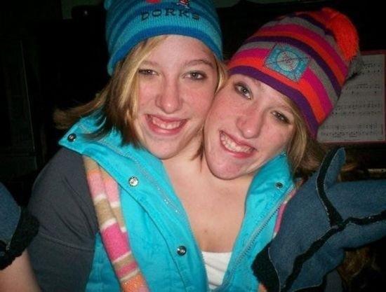 全球奇特的连体人!你一定没见过! 全球奇特的连体人!你一定没见过!