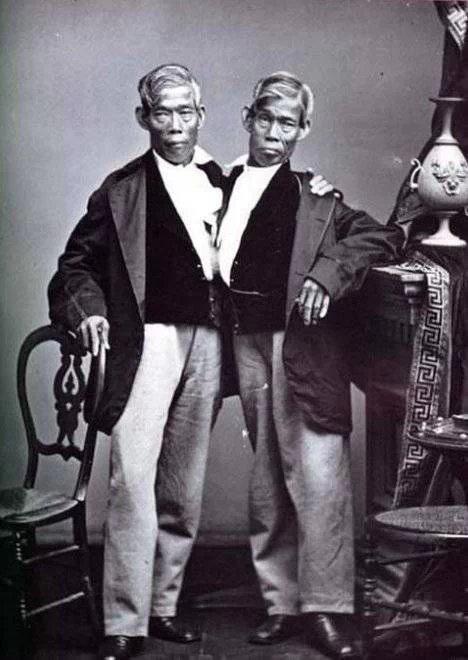 全球奇特的连体人!你一定没见过! 全球奇特的连体人!你一定没见过!